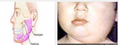 ردا على الصحة العامة.. التربية تؤكد التزامها باعطاء الاجازة الاجبارية للطلبة المصابين بمرض النكاف