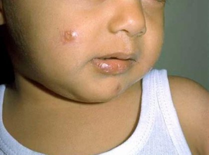 الصحة تسجل اصابات بـ(حبة بغداد) وتبدأ استعدادتها للاسهال الوبائي